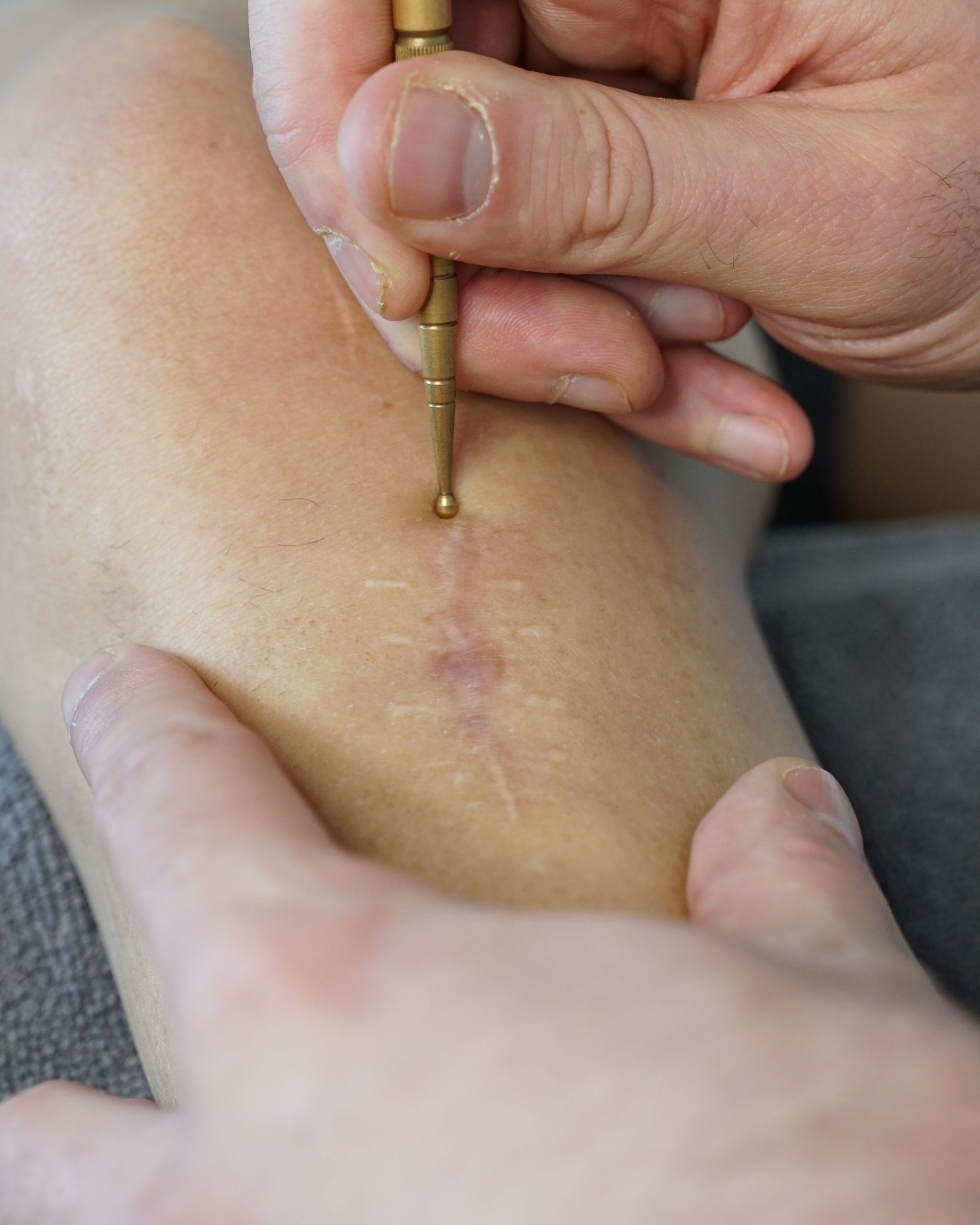 Behandlung von Schmerzen durch die Akupunkt-Massage nach Penzel